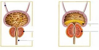 Types and forms of prostate in men