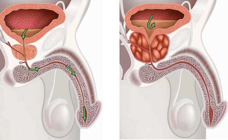 Healthy and inflamed prostate gland