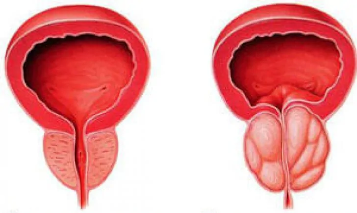 Normal prostate (left) and chronic inflamed prostate (right)